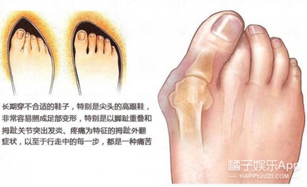 女明星的脚趾头最美_贝嫂拇指外翻手术_容祖儿拇指外翻